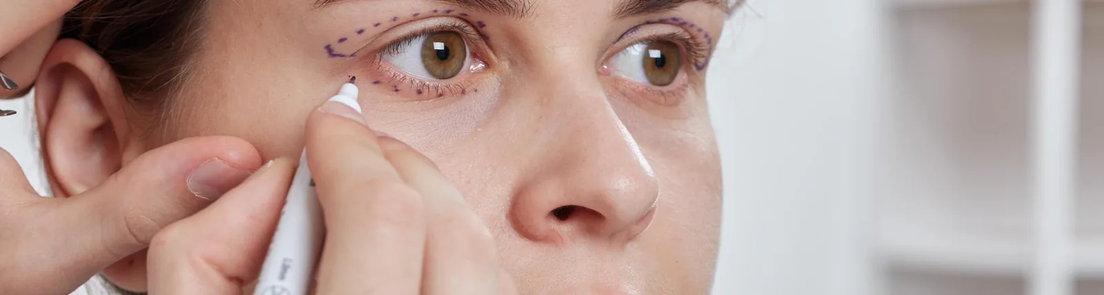 Close-up of a woman's face with purple surgical marker lines drawn around her eye area, as a medical professional applies markings near the upper eyelid in preparation for upper blepharoplasty (eyelid surgery).