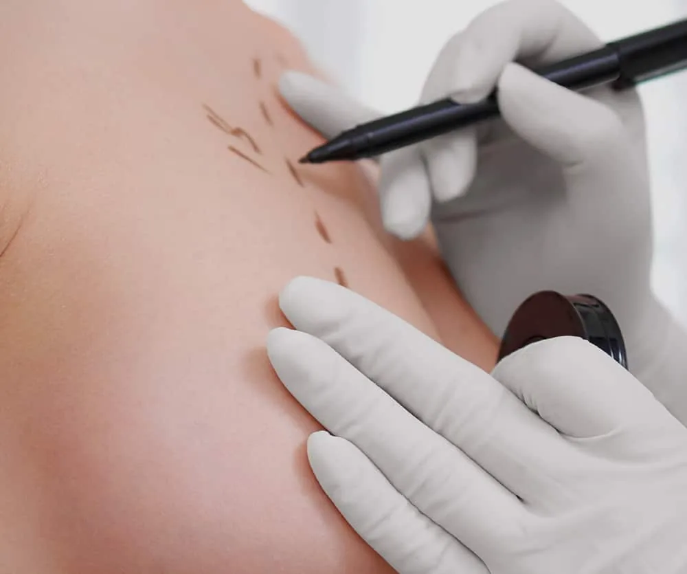 A gloved surgeon's hands using a black marker pen to draw pre-operative markings on a patient's bare chest skin in preparation for a breast lift procedure.