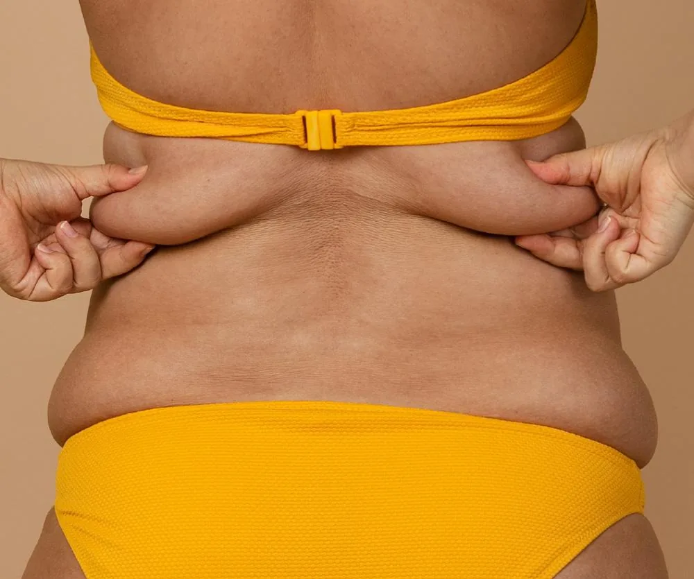 Close-up rear view of a woman in a yellow bikini pinching excess skin and fat on her lower back with both hands, illustrating body concerns related to excess skin removal surgery.