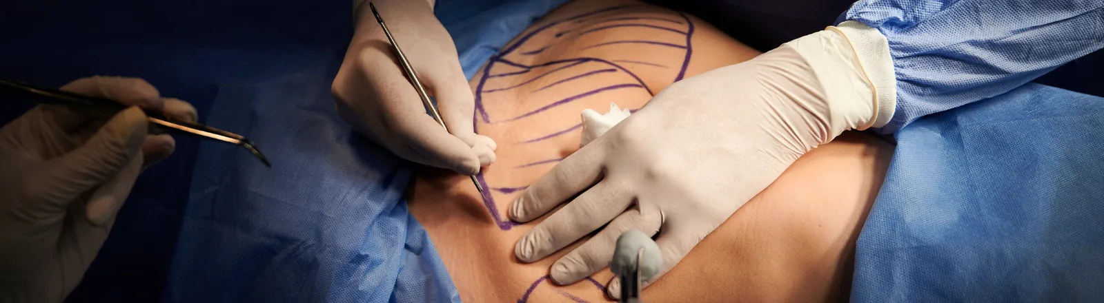 A close-up of a surgeon's gloved hands performing liposuction on a patient's abdomen, which is marked with purple surgical lines indicating fat removal areas, with surgical instruments visible and the patient draped in blue surgical cloth.