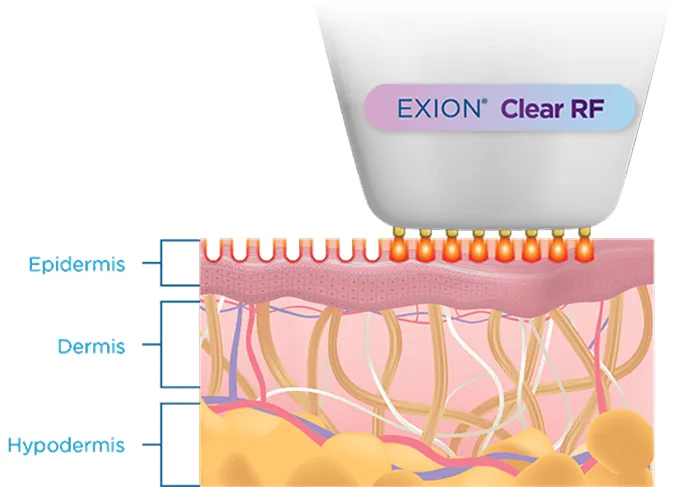 Diagram showing EXION Clear RF device applying radiofrequency treatment to skin layers: epidermis, dermis, hypodermis.