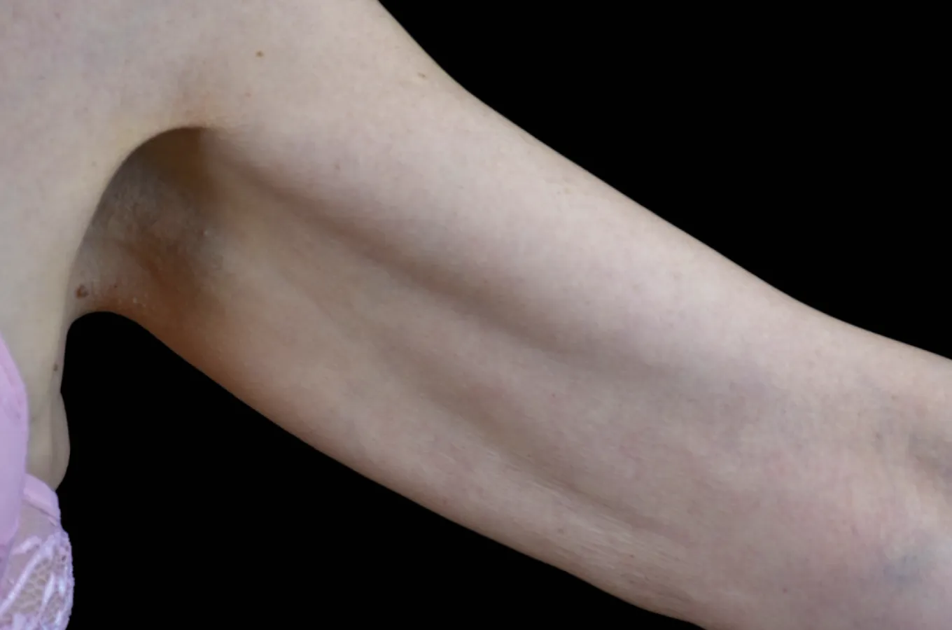 Kvinnlig arm efter BTL EMTONE-behandling visar förbättrad hudelasticitet.