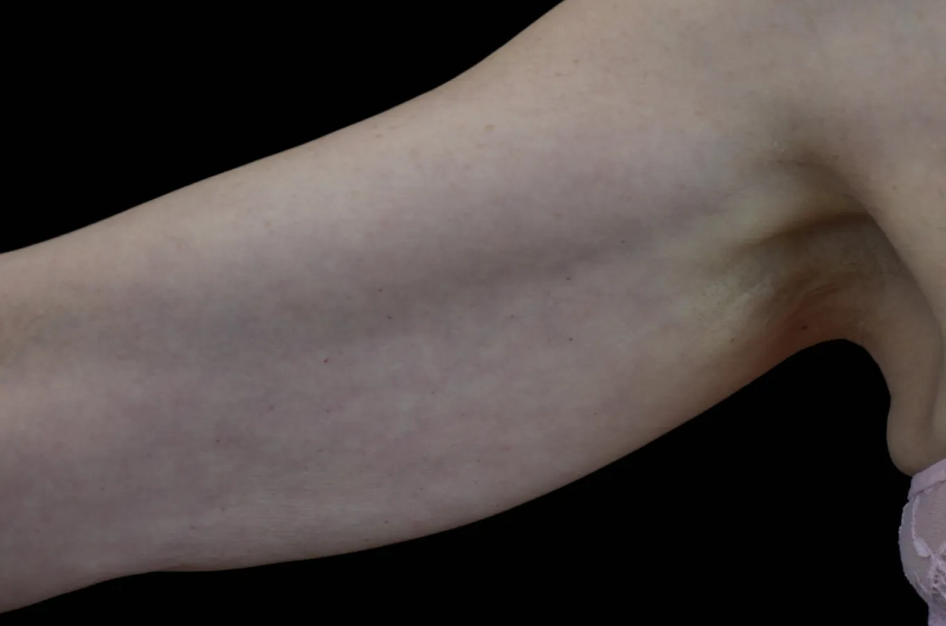 Kvinnoarm efter BTL EMTONE-behandling visar jämn hudton och minskad cellulitutseende.