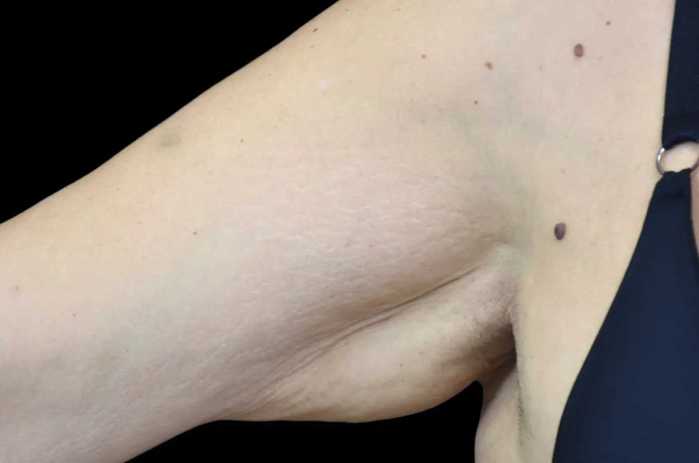 Kvinnoarms innan BTL EMTONE-behandling, sidovy.