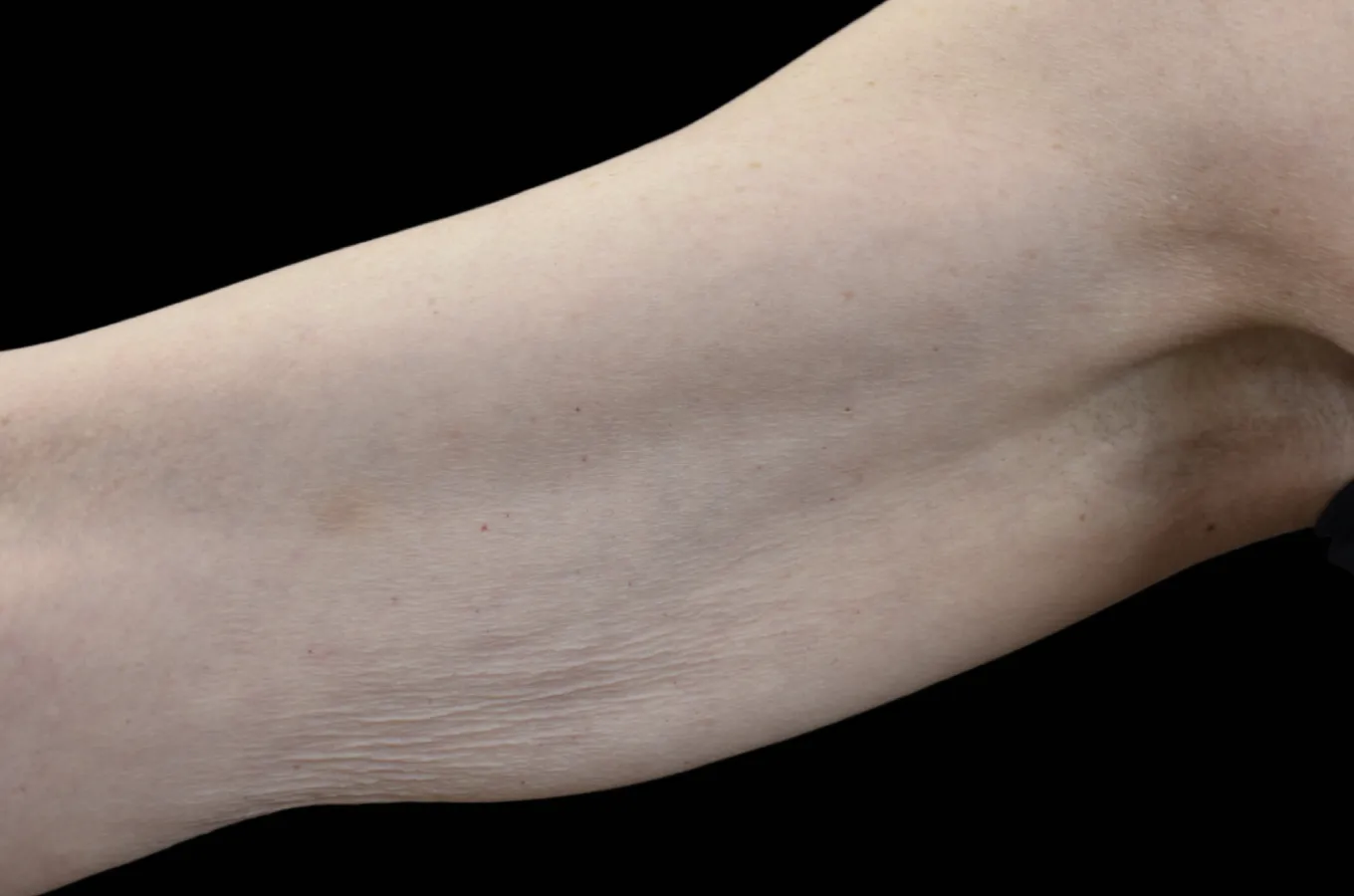 Arms före behandling med BTL EMTONE, visar hud på framsidan av armen.