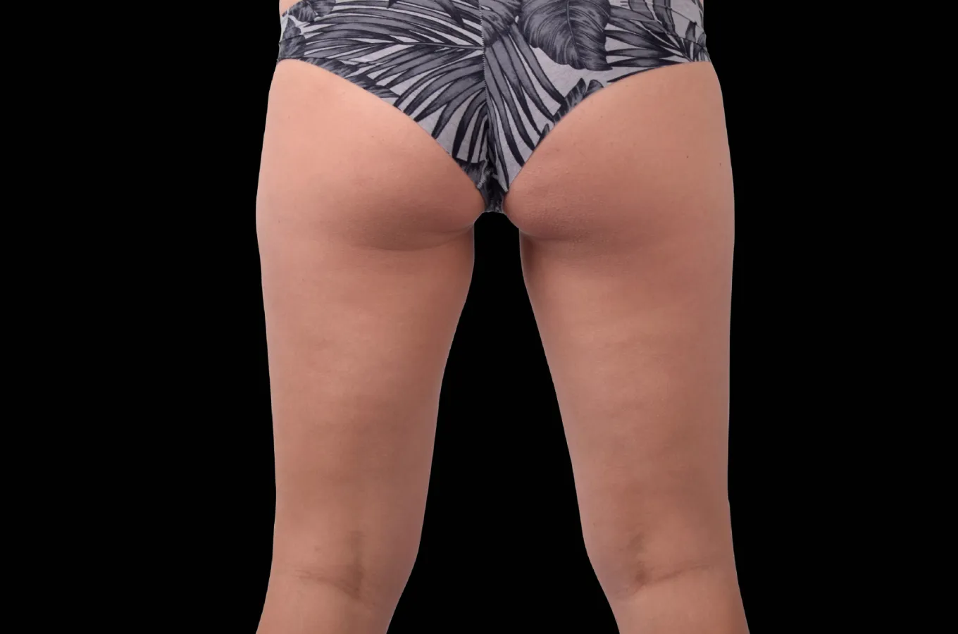 BTL EMBODY behandlingsresultat visar gluteal region efter procedur.