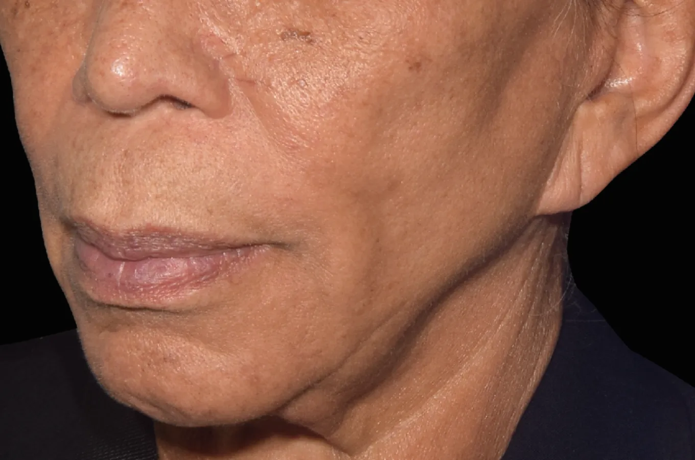 Före-bild av kvinnas ansikte visar hudytans struktur innan EMFACE-behandling med BTL.