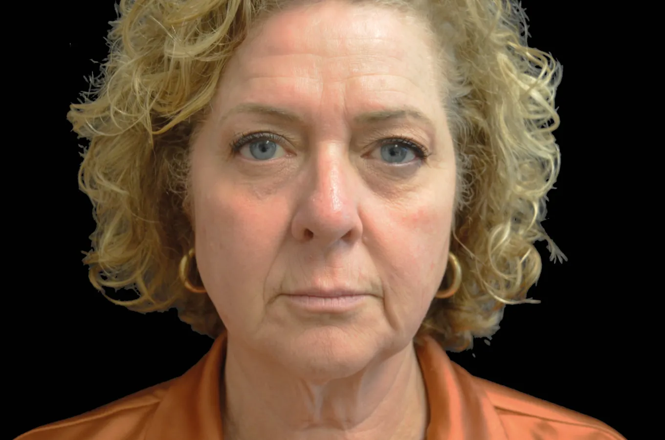 Patient med ansiktsödem före EMFACE-behandling, frontal vy (BTL).