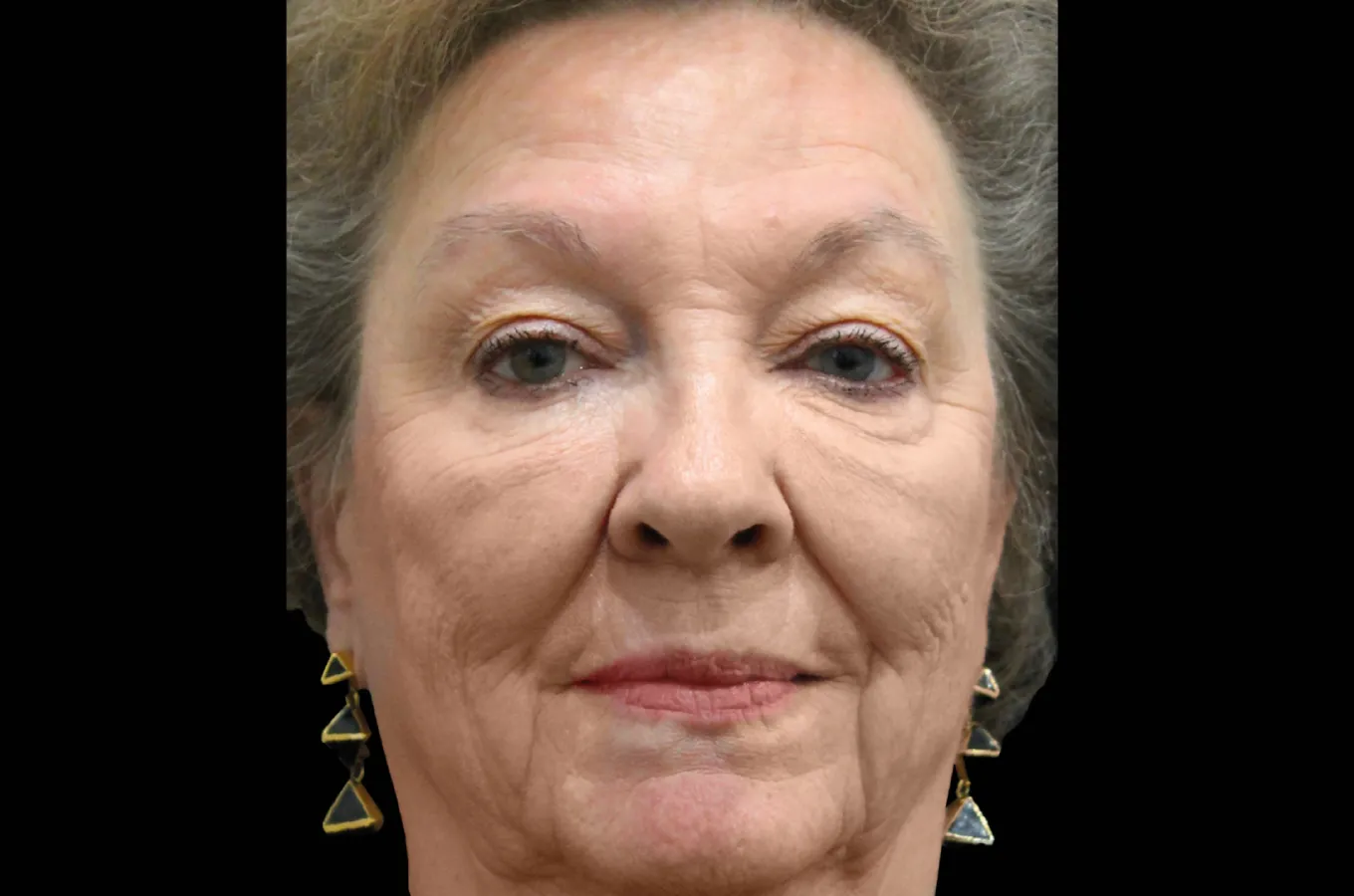 Ansiktsbehandling före EMFACE-terapi, frontal vy av kvinnlig patient som visar hudtillstånd innan BTL-behandling.