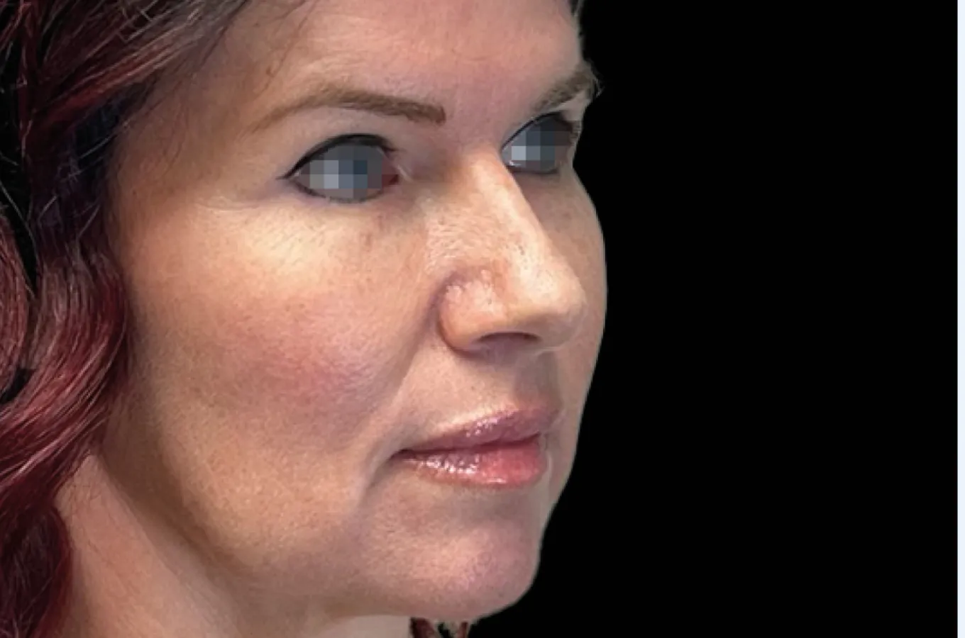Kvinnlig patient i profilvy före BTL EMFACE-behandling av ansikte.