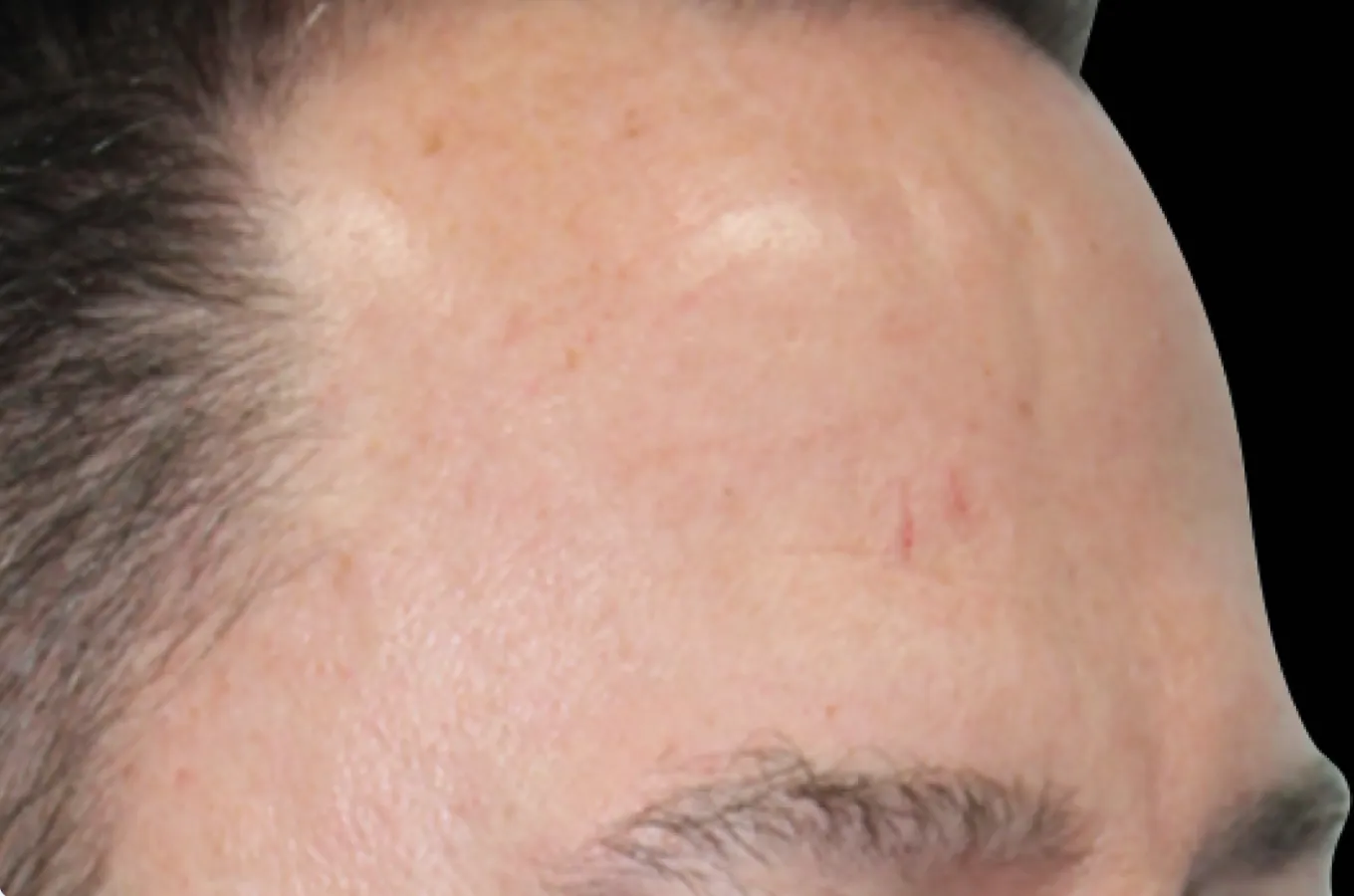 Panna på man efter BTL EMFACE-behandling visar reducerad skrynkling.