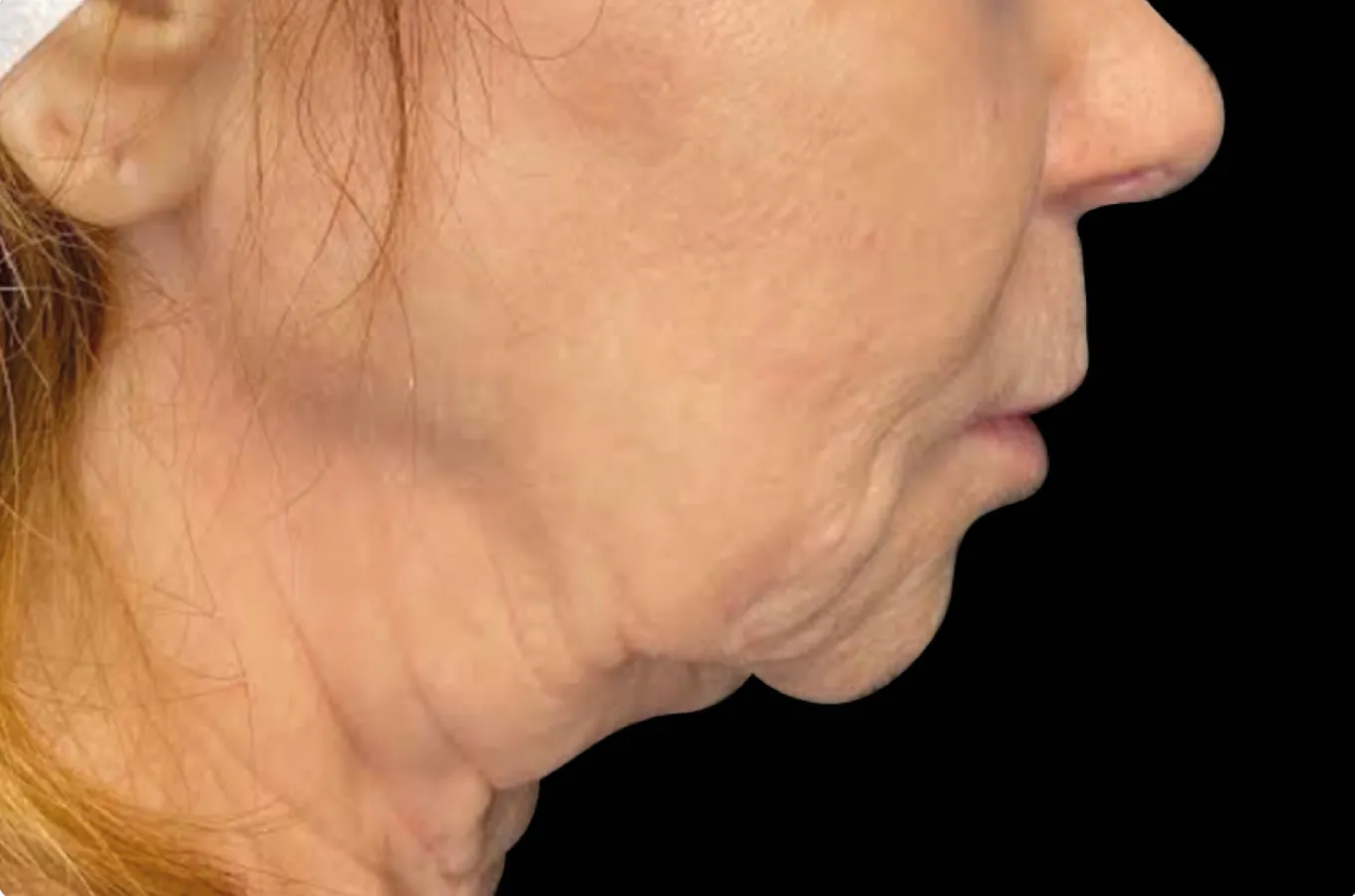 Profilbild som visar kvinnas kaklinje före BTL EMFACE-behandling.