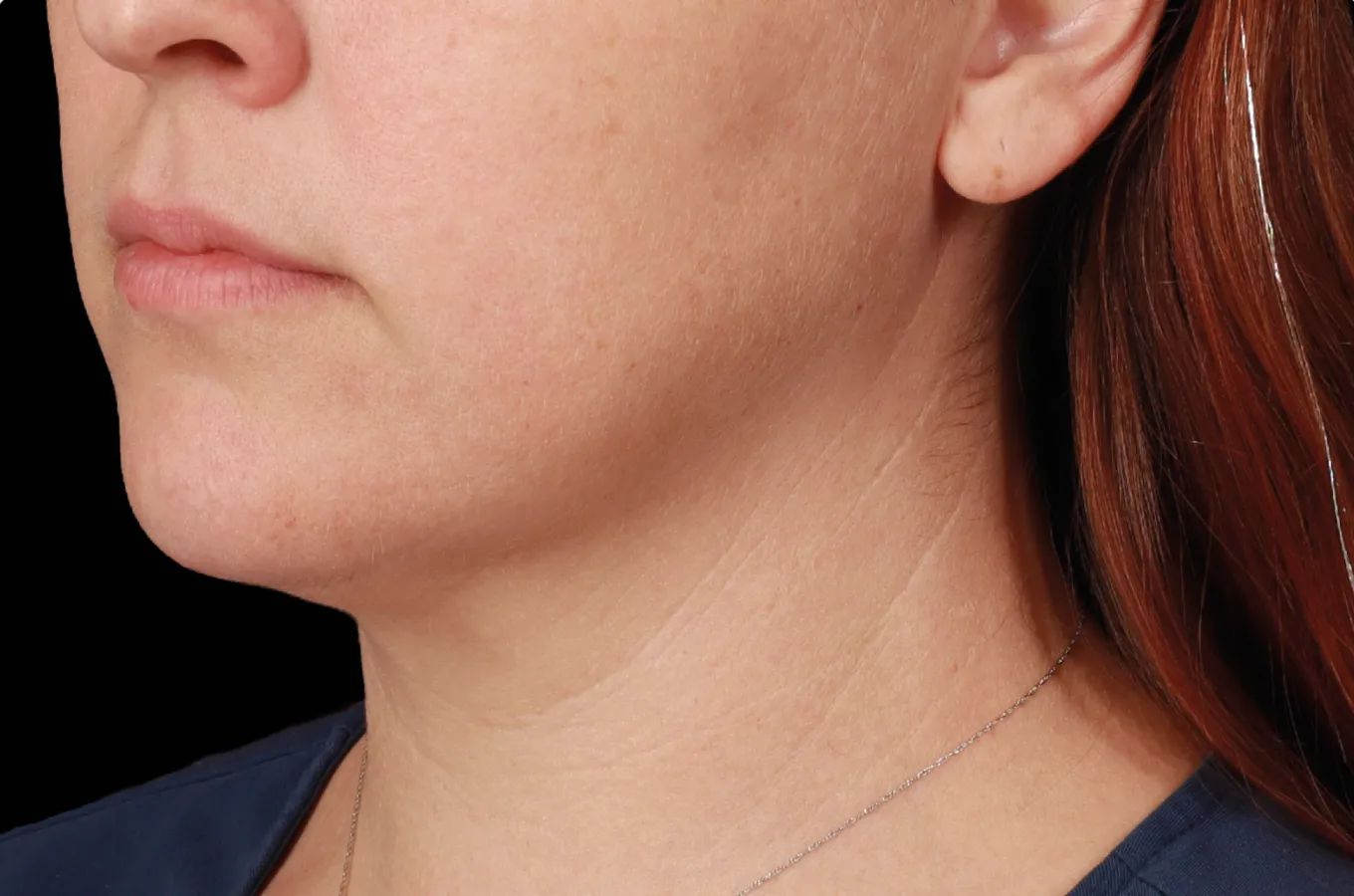 Efterbehandlingsfoto av hals och submental region som visar resultat efter BTL EMFACE-behandling.