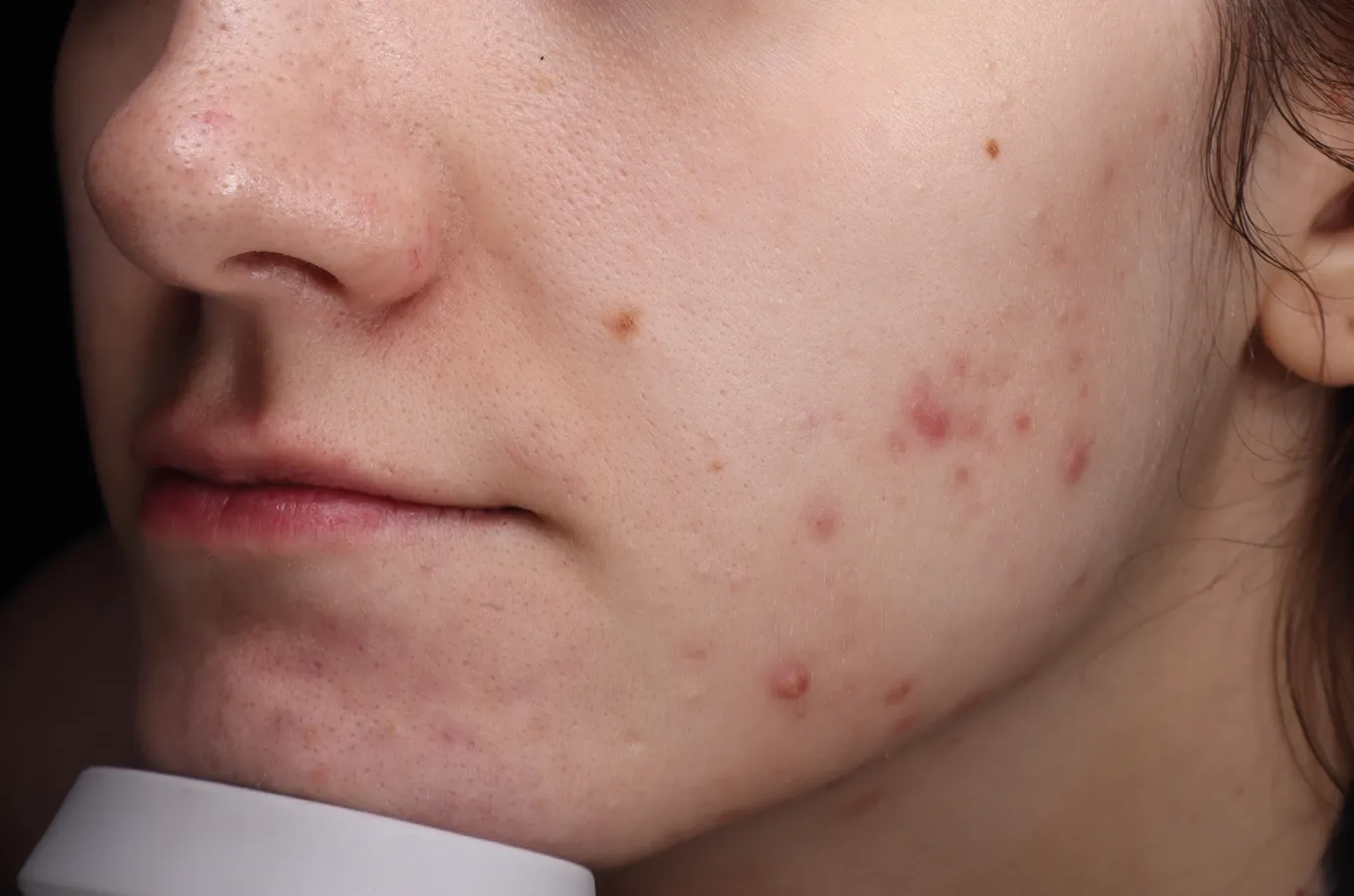Ansiktshud efter BTL EMFUSION-behandling visar reducerad acne och förbättrad hudstruktur.