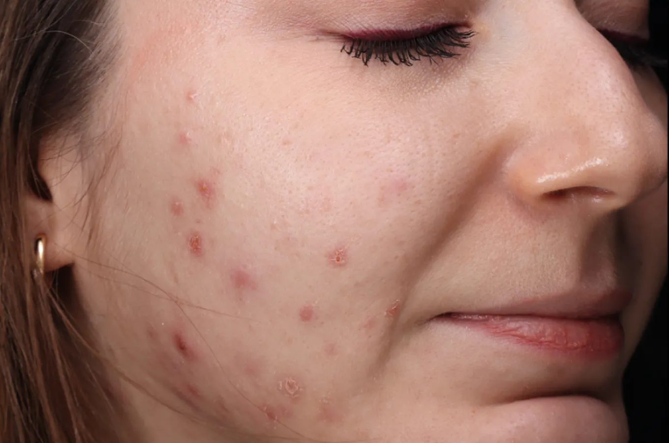 Kvinnas ansikte i profilvy före BTL EMFUSION-behandling, visar acne och hudojämnheter på kind och käkline.