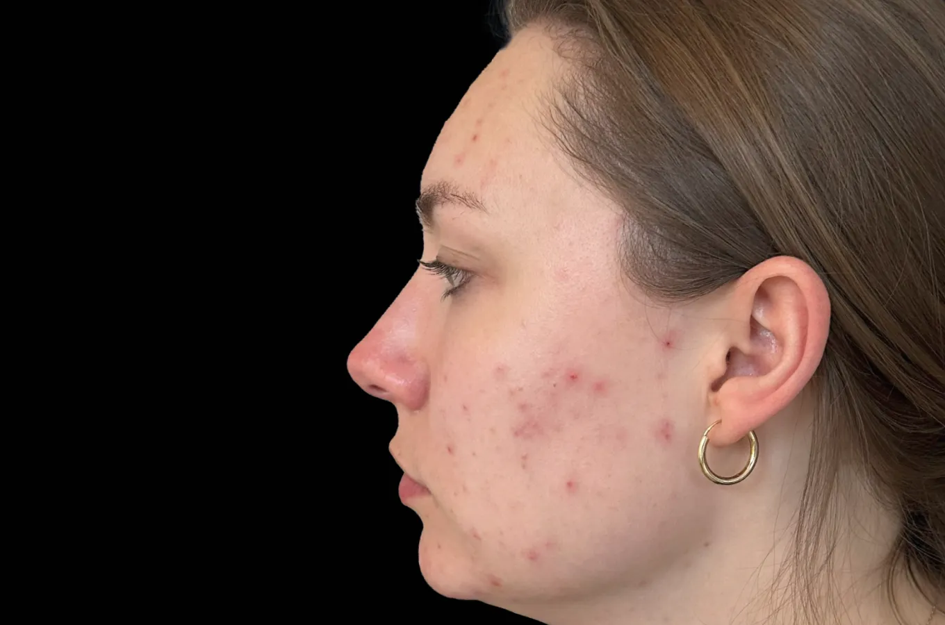Kvinnas ansikte i profilvy före BTL EMFUSION-behandling, visar acne och hudbristningar.