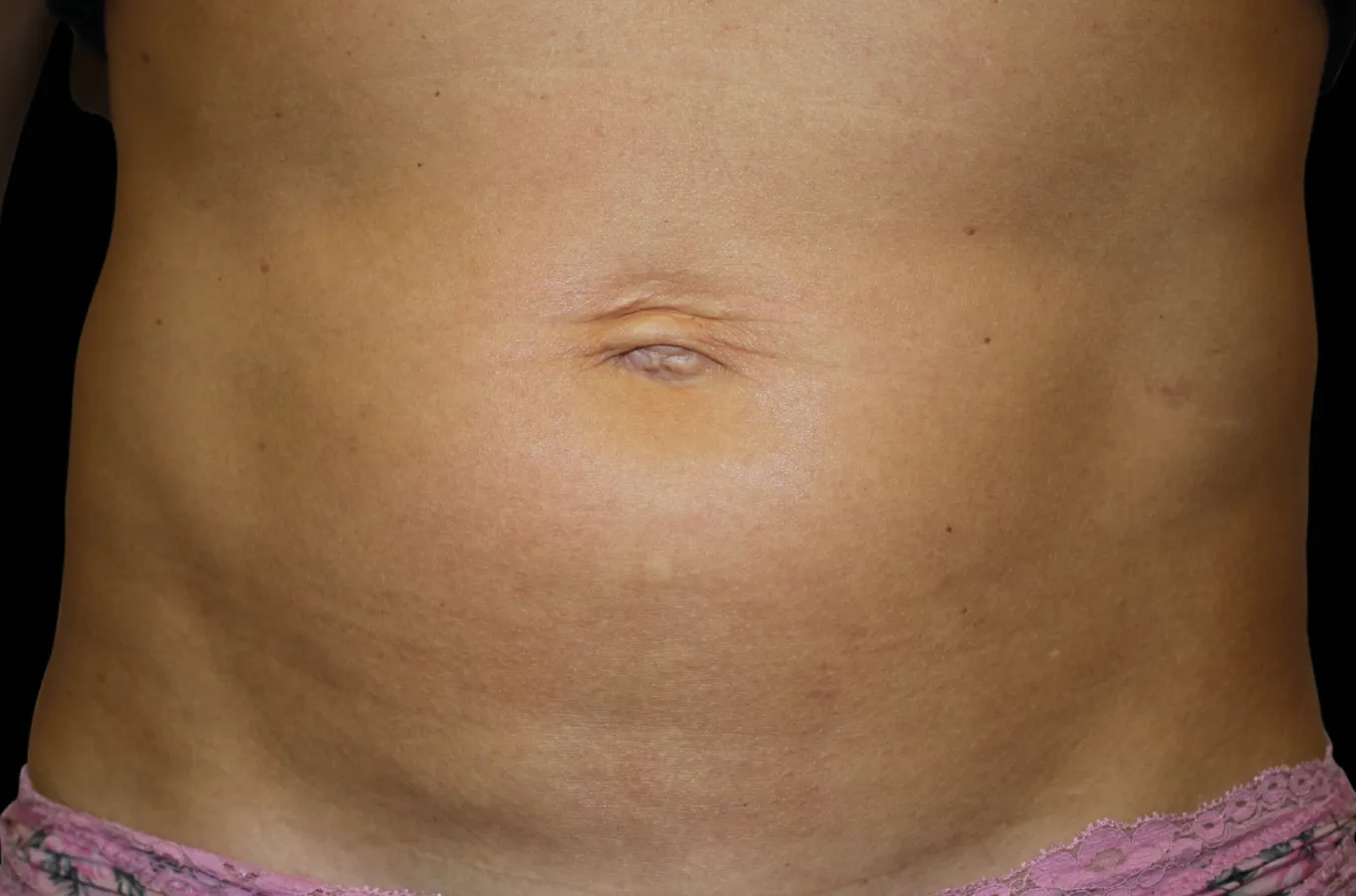 Abdominal område efter EMSCULPT-behandling med BTL, visar minskad bukfetma och förbättrad muskeldefiniering.