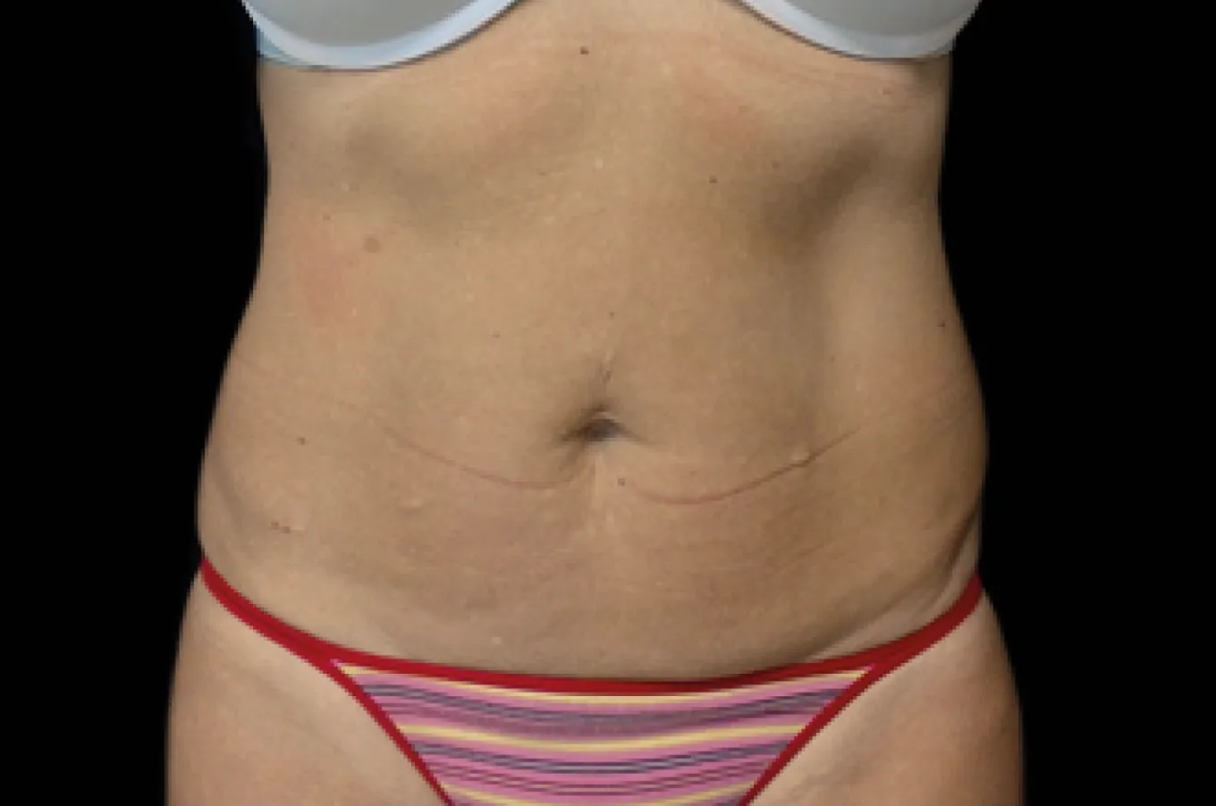 Abdominal område efter EMSCULPT-behandling med BTL-utrustning, visar minskad fettpålagring och förbättrad muskeltonering.