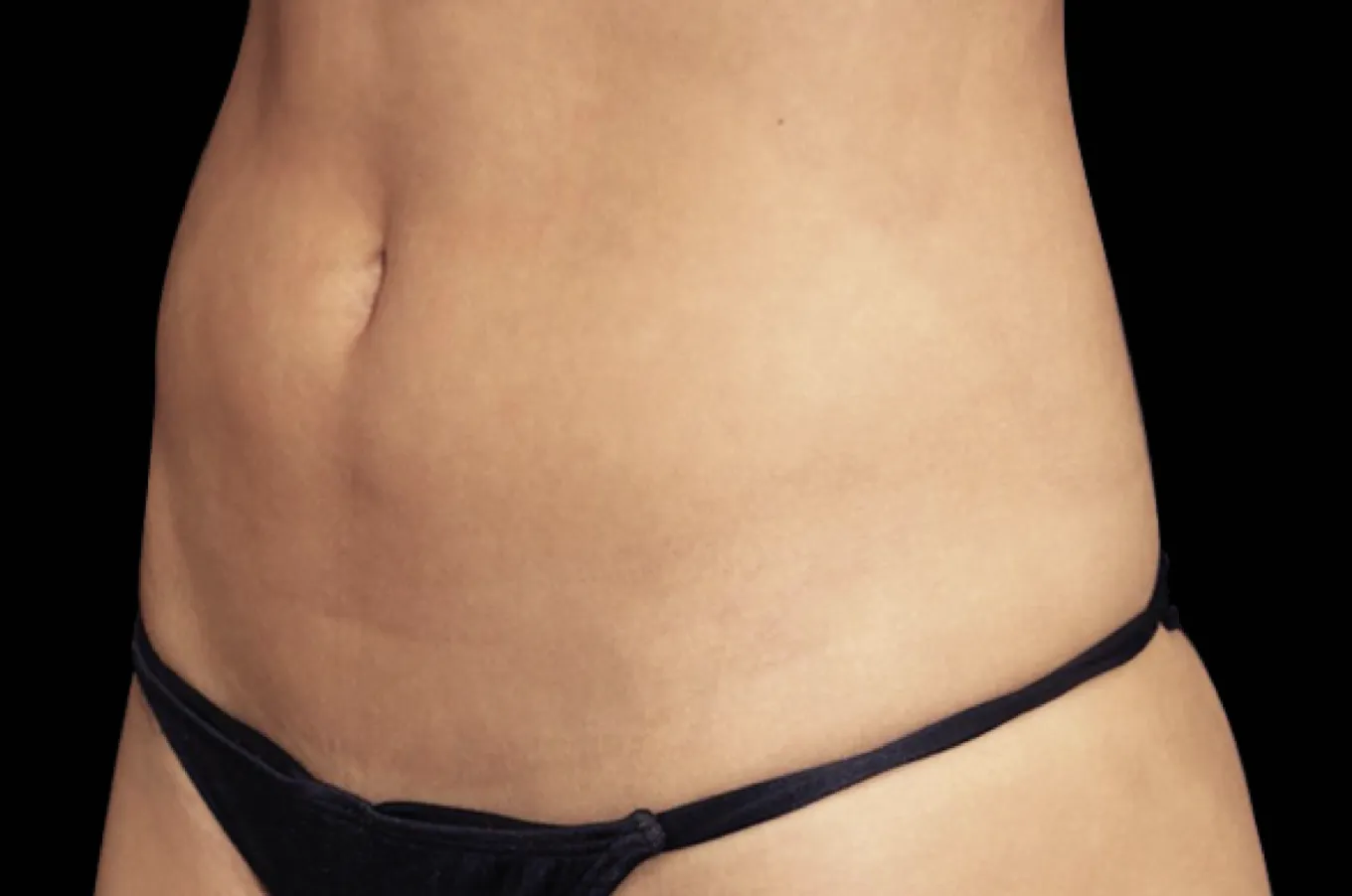 Abdominal område efter BTL EMSCULPT-behandling, frontalvy.