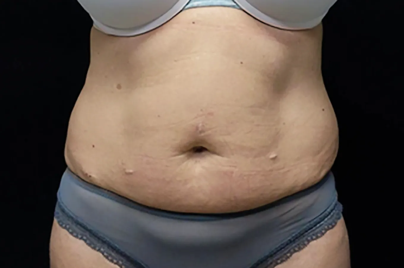 Före EMSCULPT-behandling: patientens abdominala område visar initial muskelton och hudstruktur, dokumenterat för (BTL).