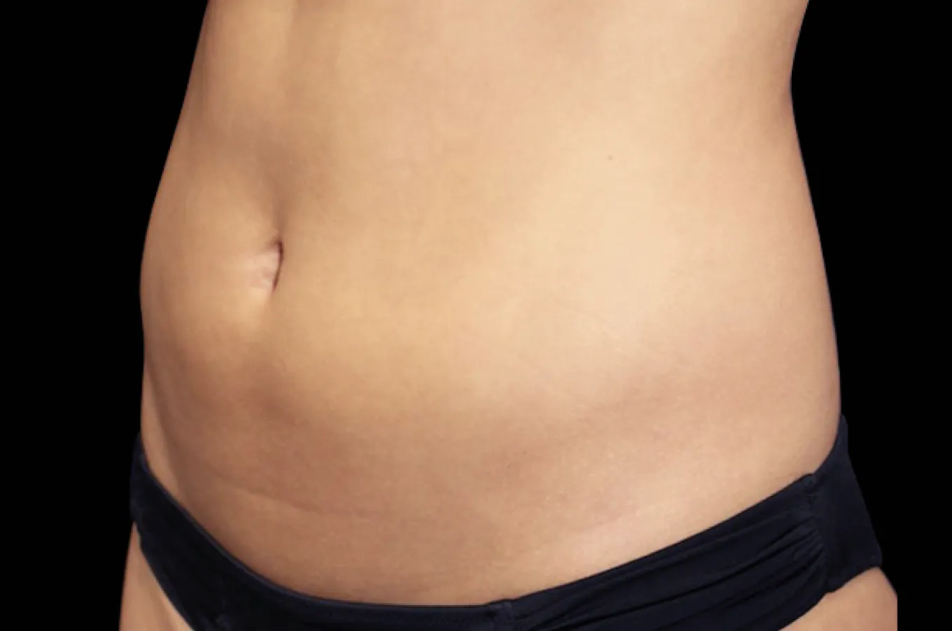 Före BTL EMSCULPT-behandling visas kvinnlig abdominal region från framsida.