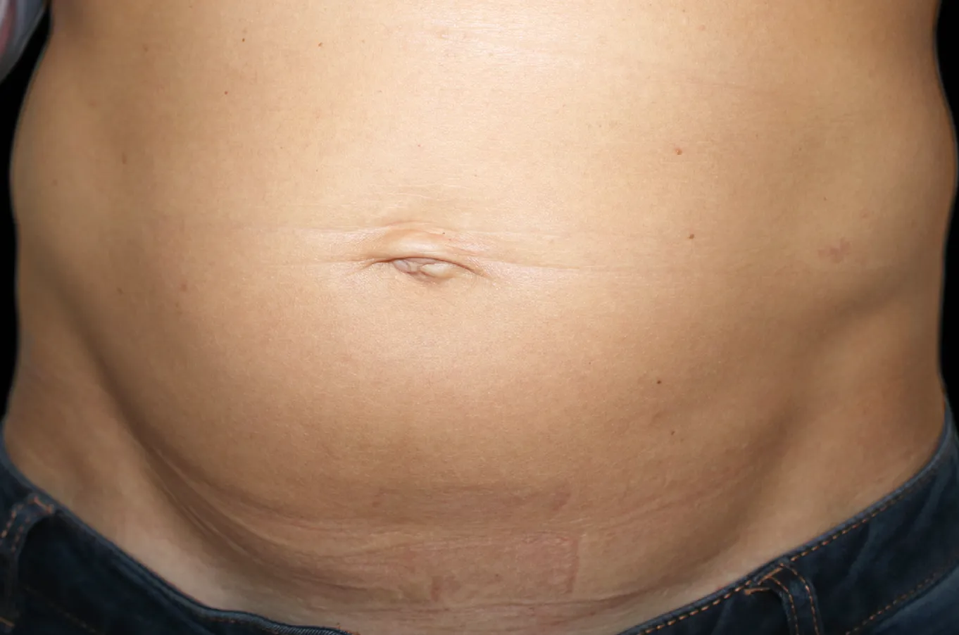 Före-bild av abdominalt område från en patientsom genomgår BTL EMSCULPT-behandling för muskelstimulering.