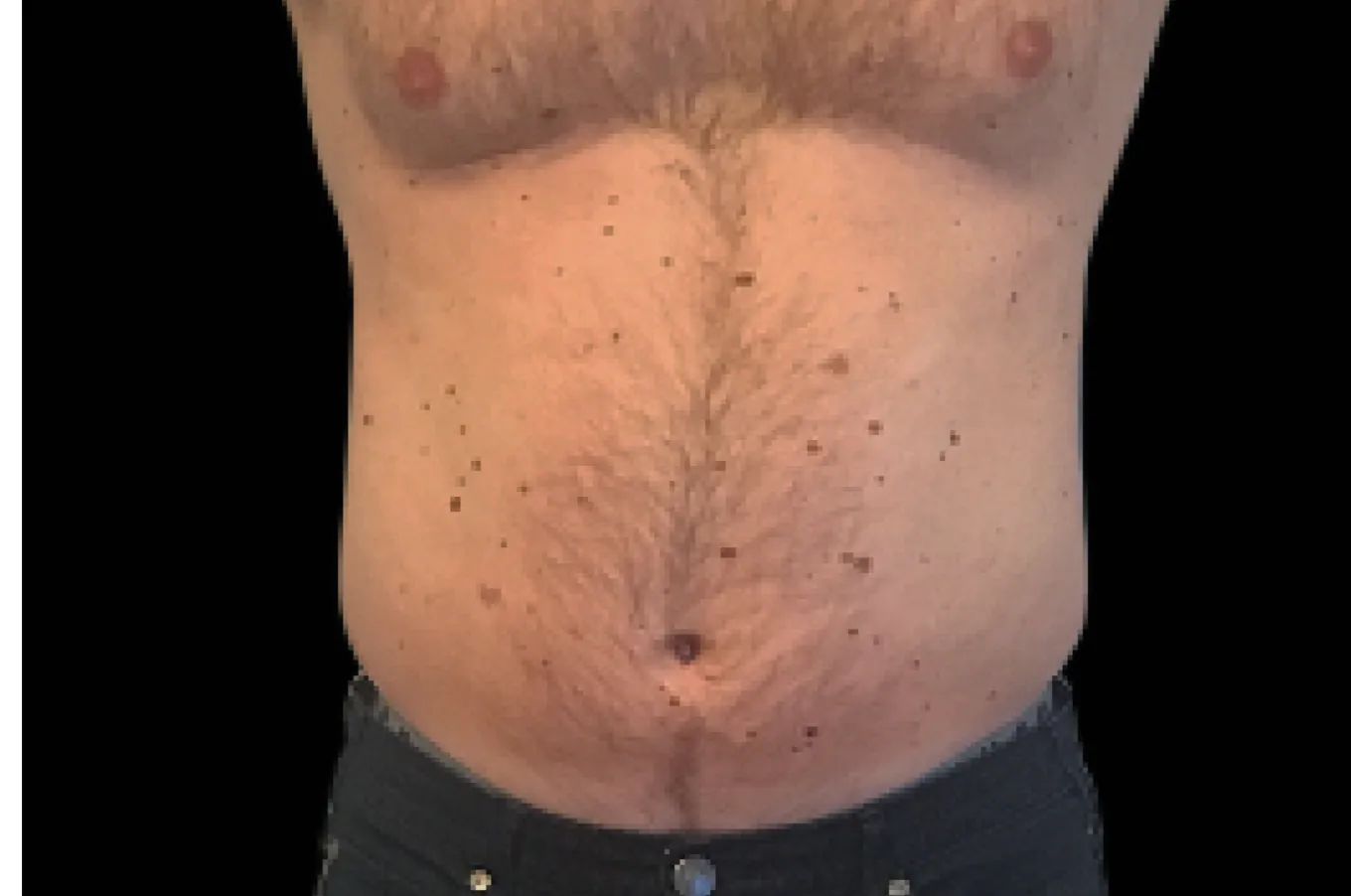 Man med exponerad buk före EMSCULPT-behandling med BTL-teknik, frontvyn.