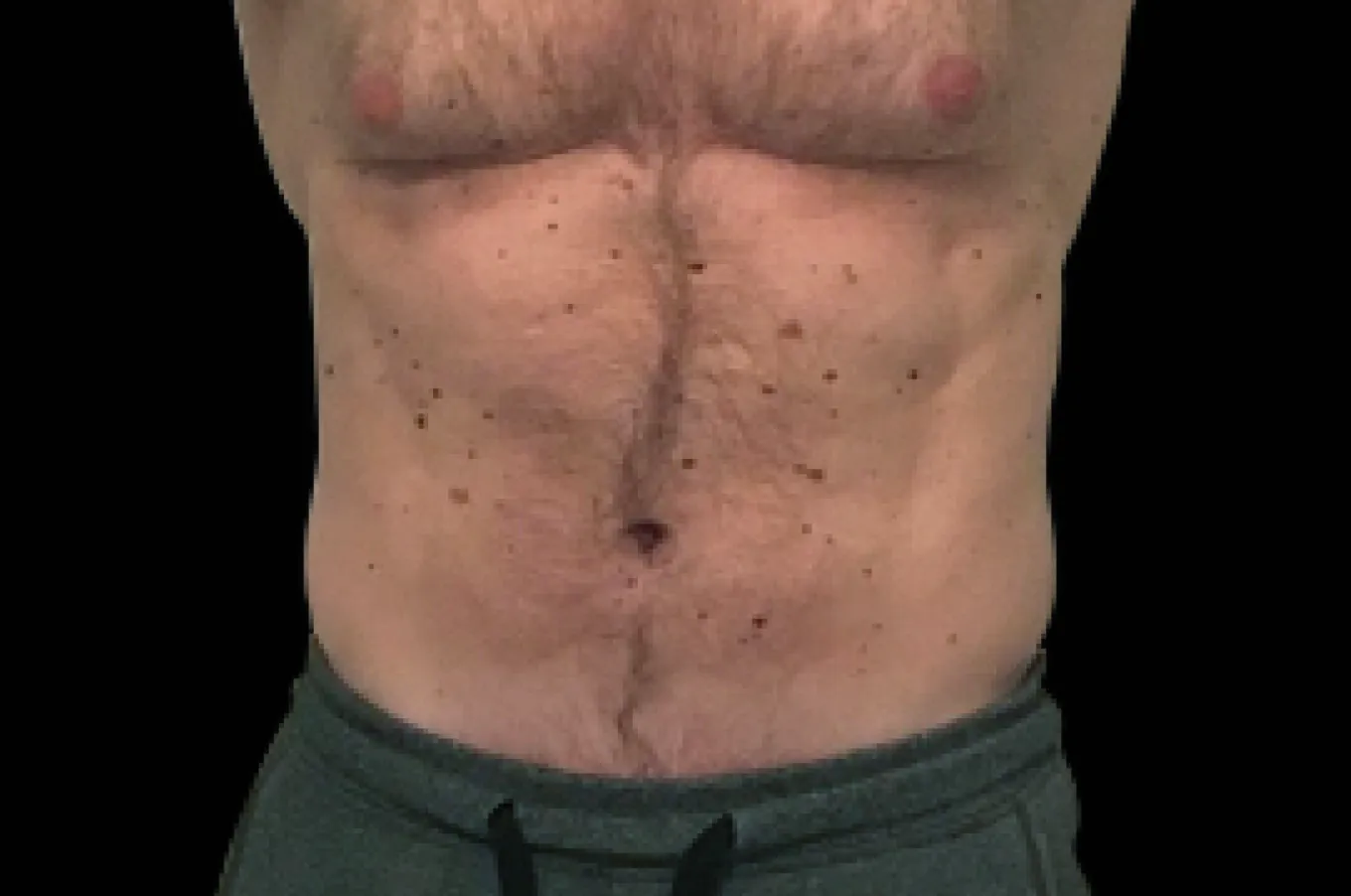 Man visar resultat efter EMSCULPT-behandling med muskeldefiniering i abdominal region med BTL-teknik.