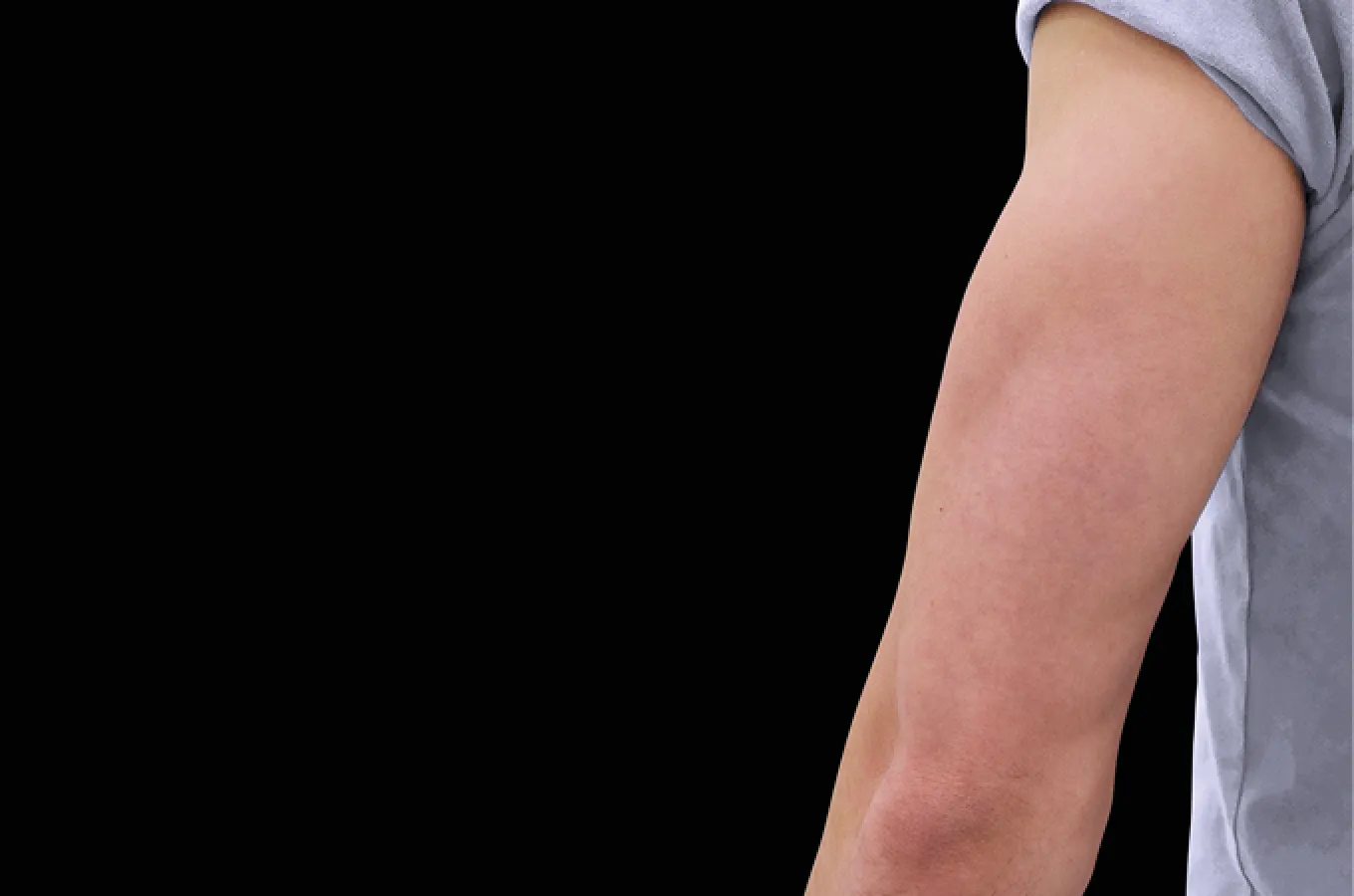 Bakre del av arm som visar muskeltonus efter EMSCULPT-behandling med BTL.