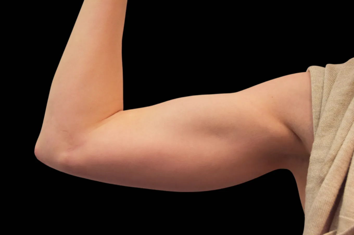 Kvinnlig arm från framansida efter EMSCULPT-behandling med BTL, visar definierad muskulatur och straffad hud.