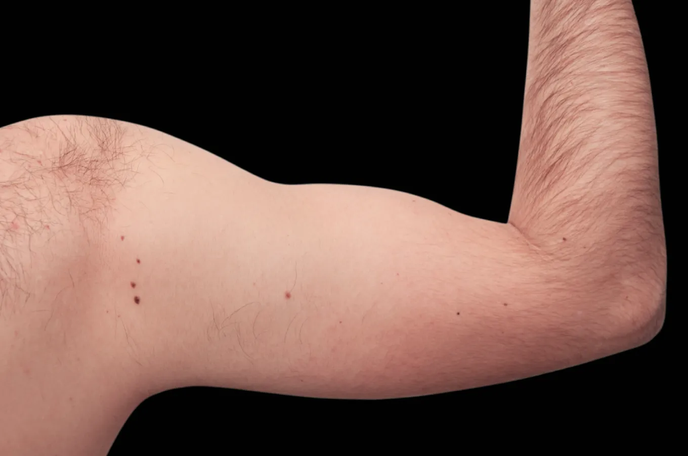 Manlig arm från framsidan före EMSCULPT-behandling med BTL-utrustning.
