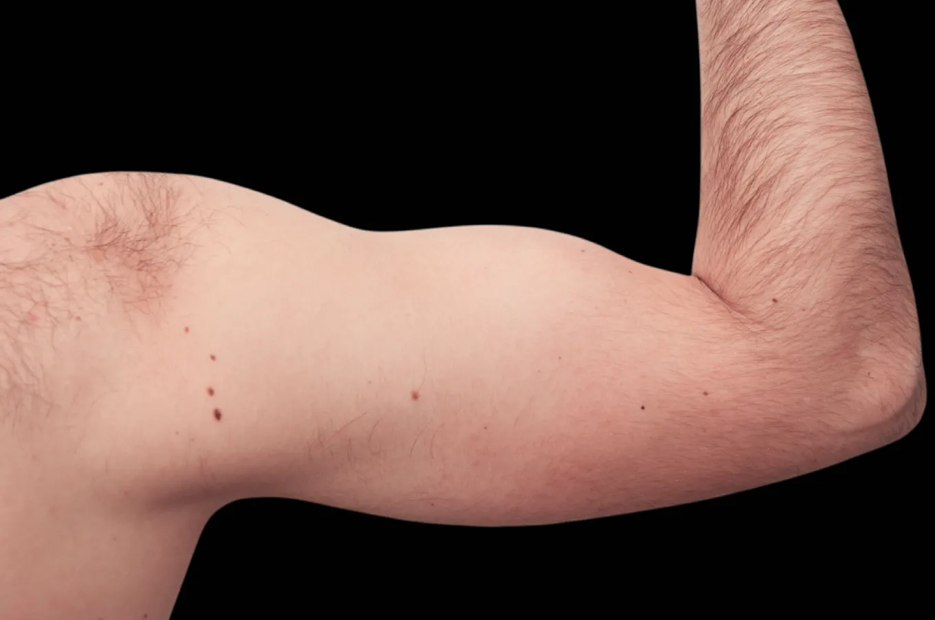 Armmuskulatur efter EMSCULPT-behandling med BTL, frontvyn.