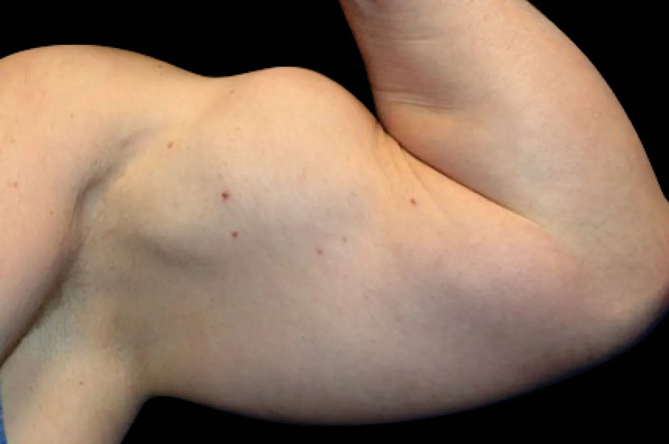 Muskulös framarm och biceps efter BTL EMSCULPT-behandling, framvinkel.