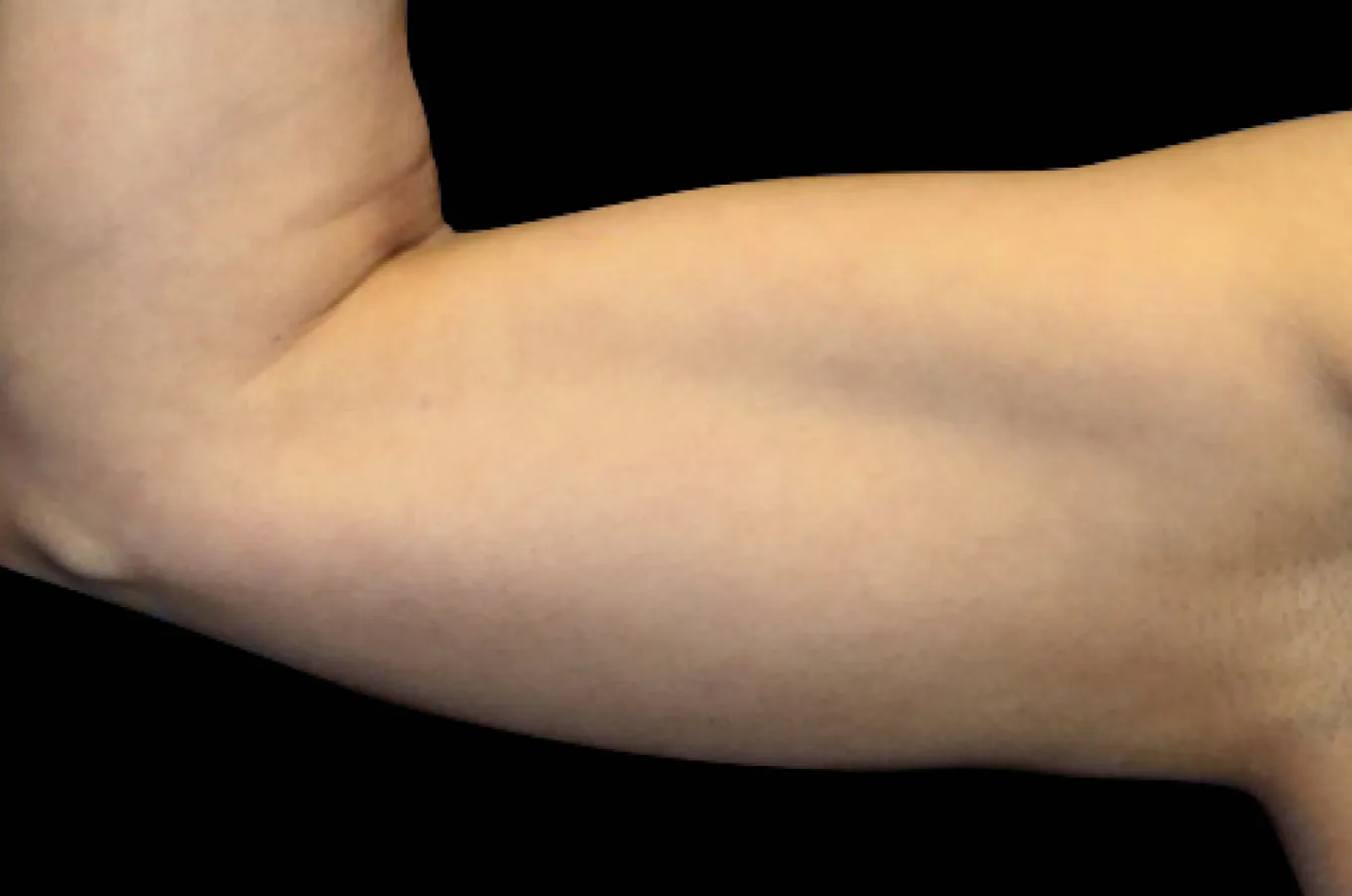 Framåtbuktad arm från sidan som visar muskeltonning efter EMSCULPT-behandling med BTL.