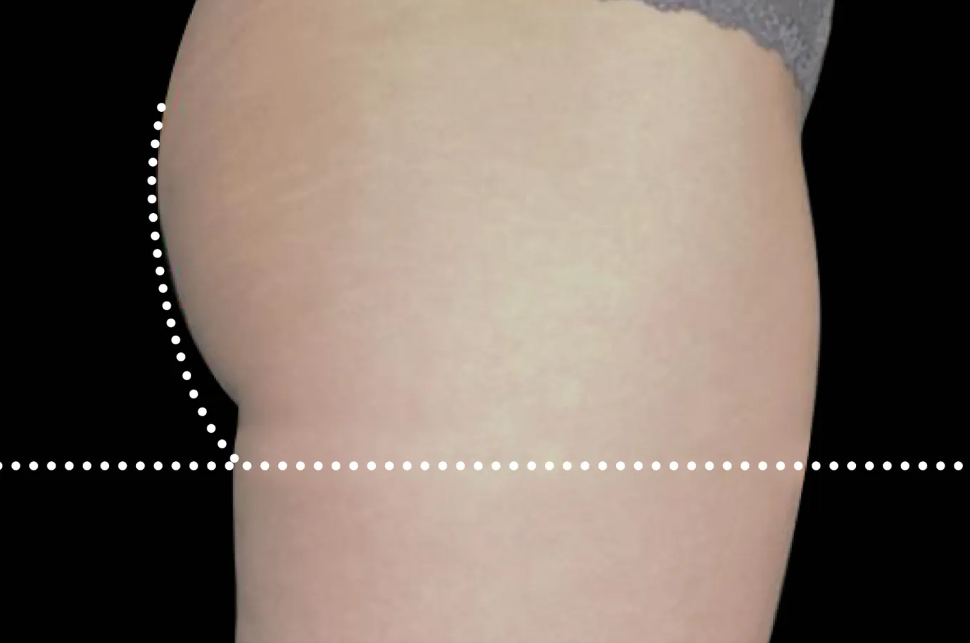 BTL EMSCULPT efter-behandling visar straffad och lyfthoppad rumpa från sidan.