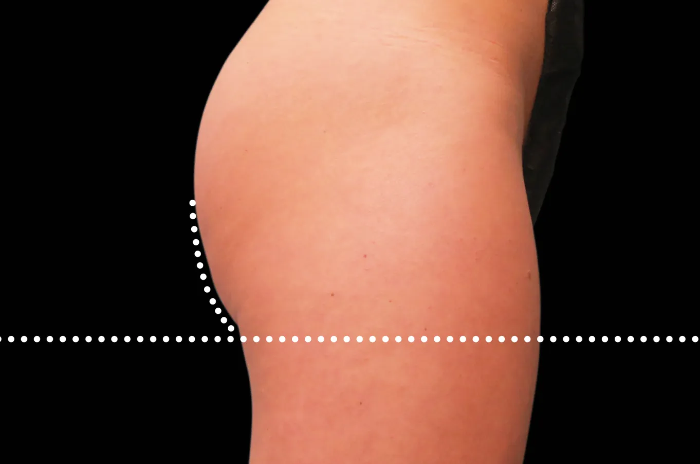 BTL EMSCULPT behandlingsresultat visar straffad och lyftad rumpa efter behandling.