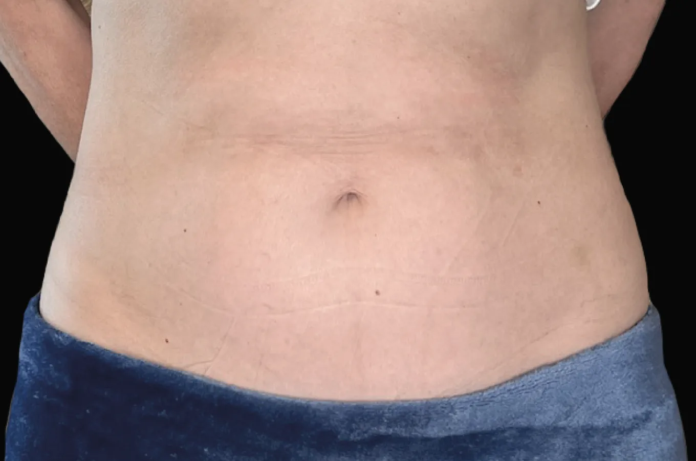 Kvinnas buk efter BTL EMSCULPT NEO-behandling visar straffad bukmuskulatur och reducerad fettavlagring.
