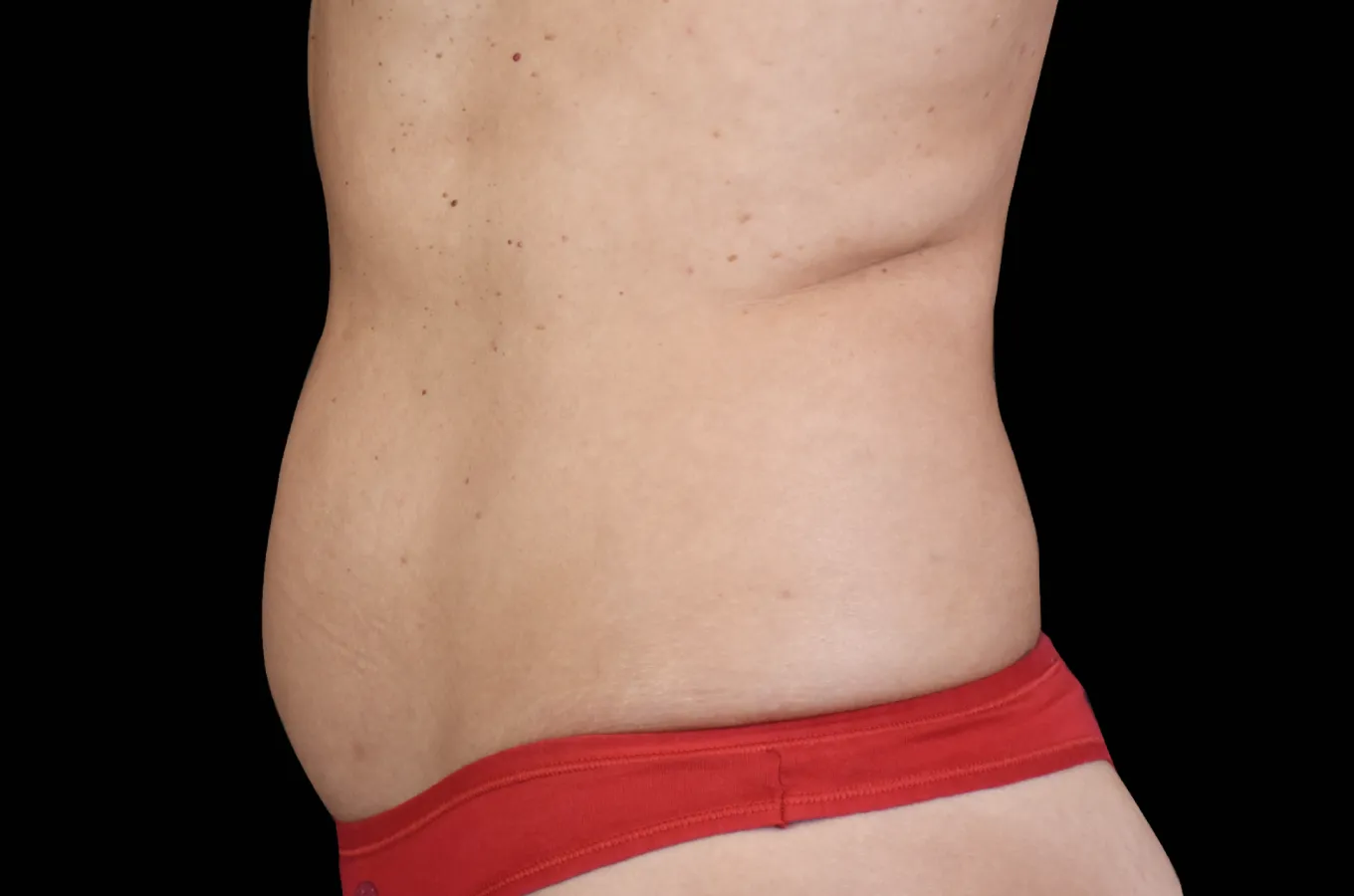 Kvinnas buk efter BTL EMSCULPT NEO-behandling visar straffat resultat.