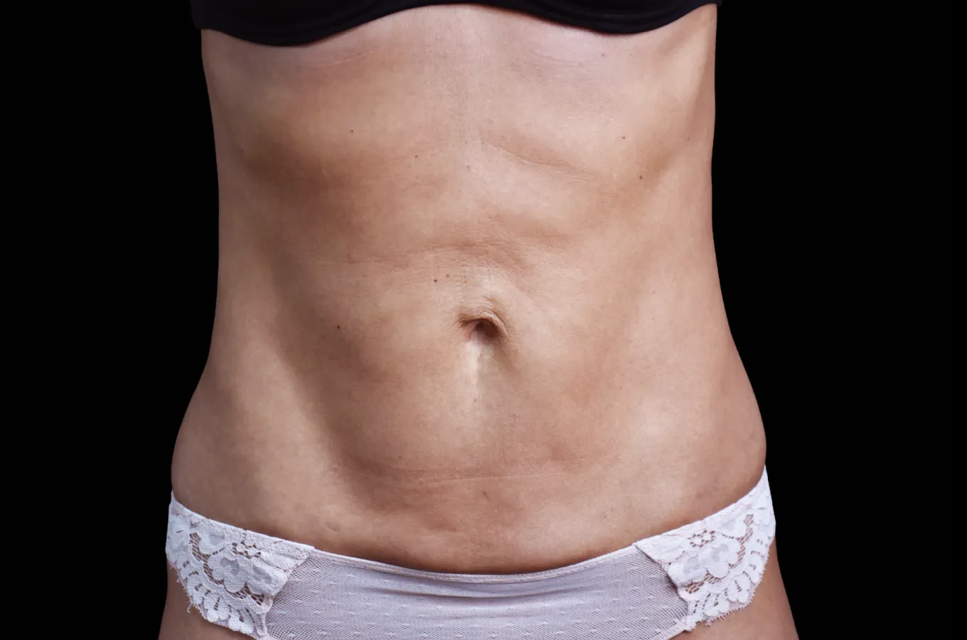 Abdominal bålkropp efter BTL EMSCULPT NEO-behandling, frontal vy.