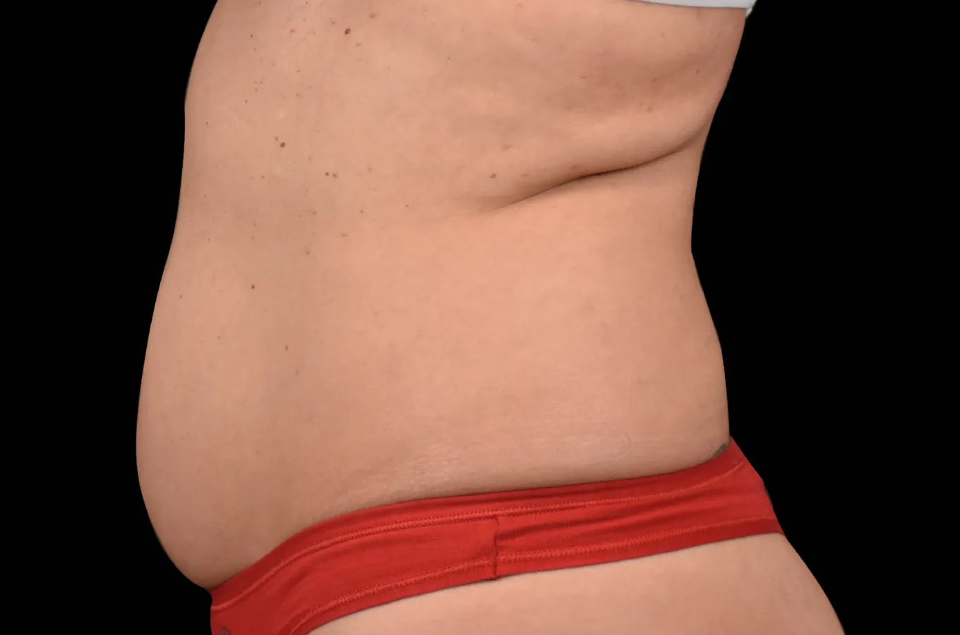 Före-behandlingsbild av bukaregel från sidan, visandes resultat möjlig med BTL EMSCULPT NEO.
