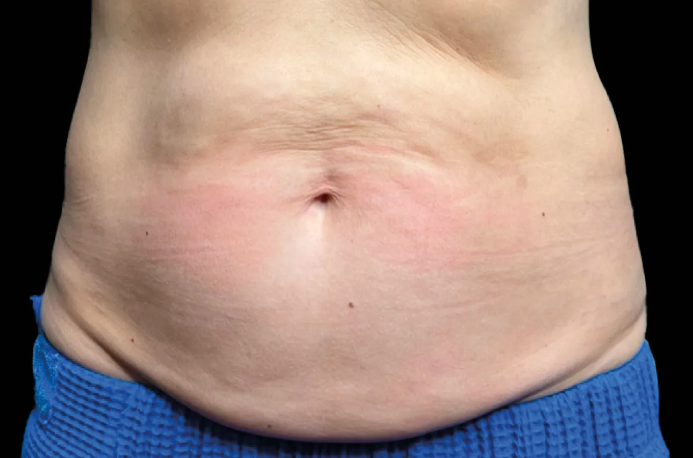 Före-bild av kvinnas mage som visar utgångstillståndet före BTL EMSCULPT NEO-behandling.