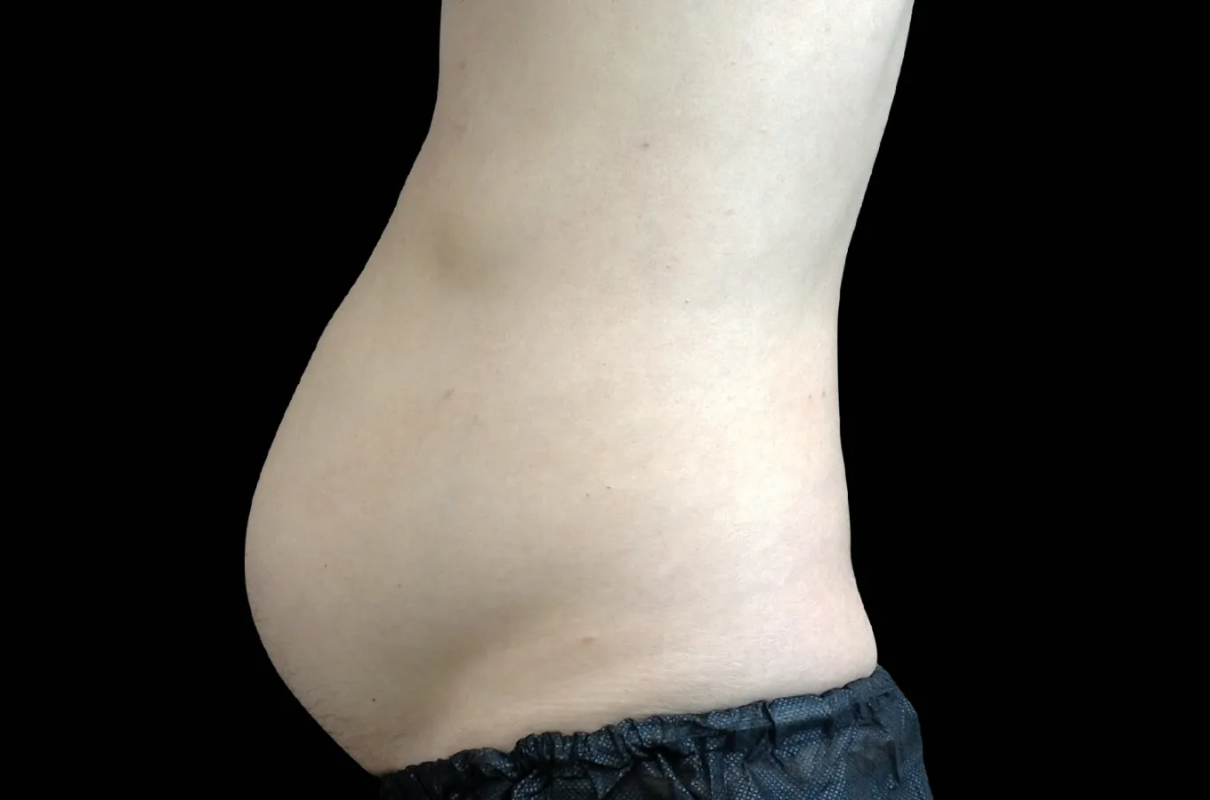 Man med synlig bukfetma före BTL EMSCULPT NEO-behandling, profilvy från höger sida.