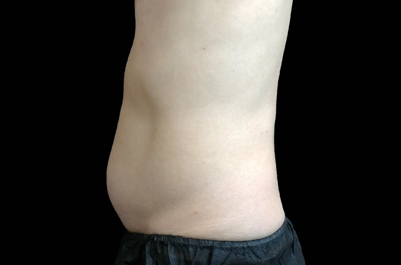 Man visar sitt buk efter behandling med BTL EMSCULPT NEO.