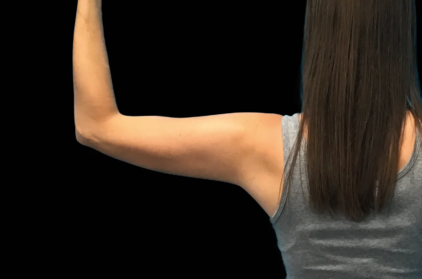Kvinnas armar efter BTL EMSCULPT NEO-behandling, framifrån.