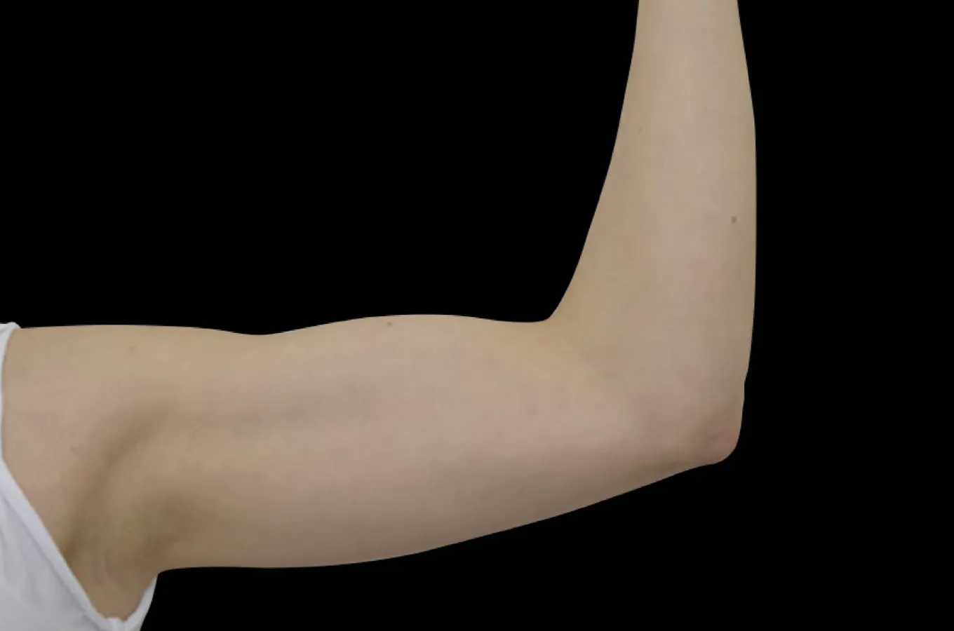 Kvinnas arm efter BTL EMSCULPT NEO-behandling visar definierad muskulatur.