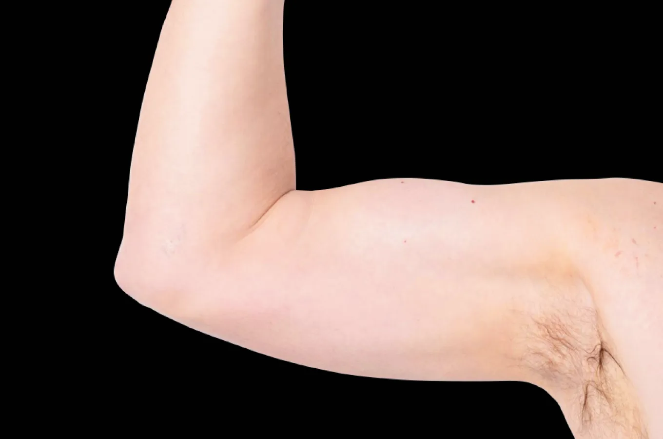 Man visar armmuskulatur efter behandling med BTL EMSCULPT NEO.