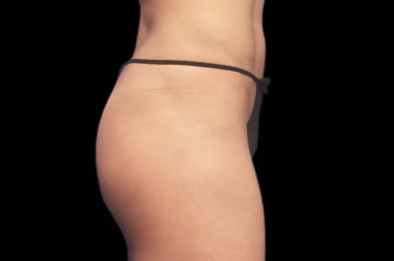 Kvinnlig rumpa efter BTL EMSCULPT NEO-behandling, visar höfter från sidan.