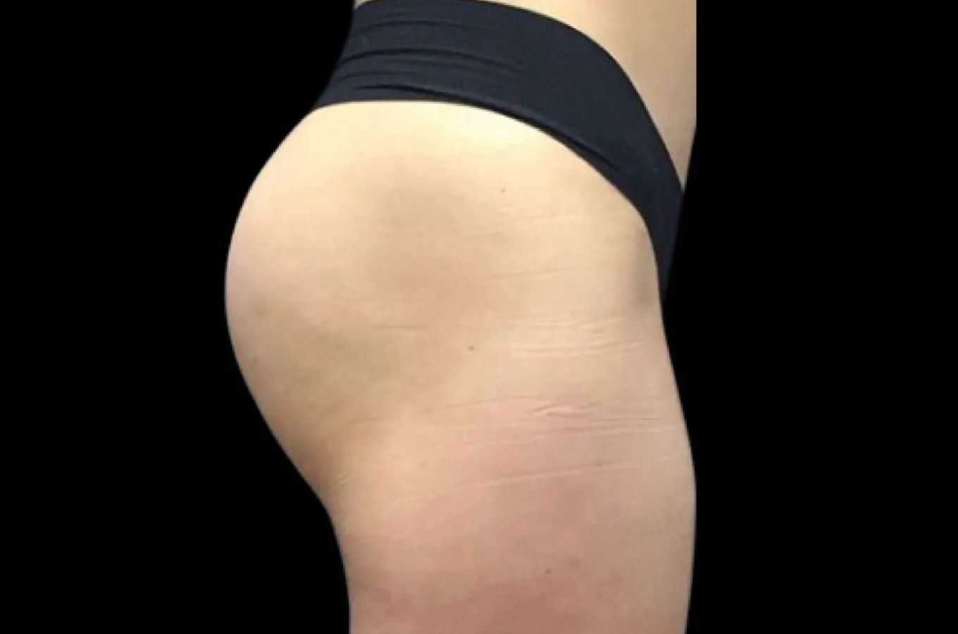 BTL EMSCULPT NEO efter-behandling visar straffad och lyfts baksida från sidoperspektiv.
