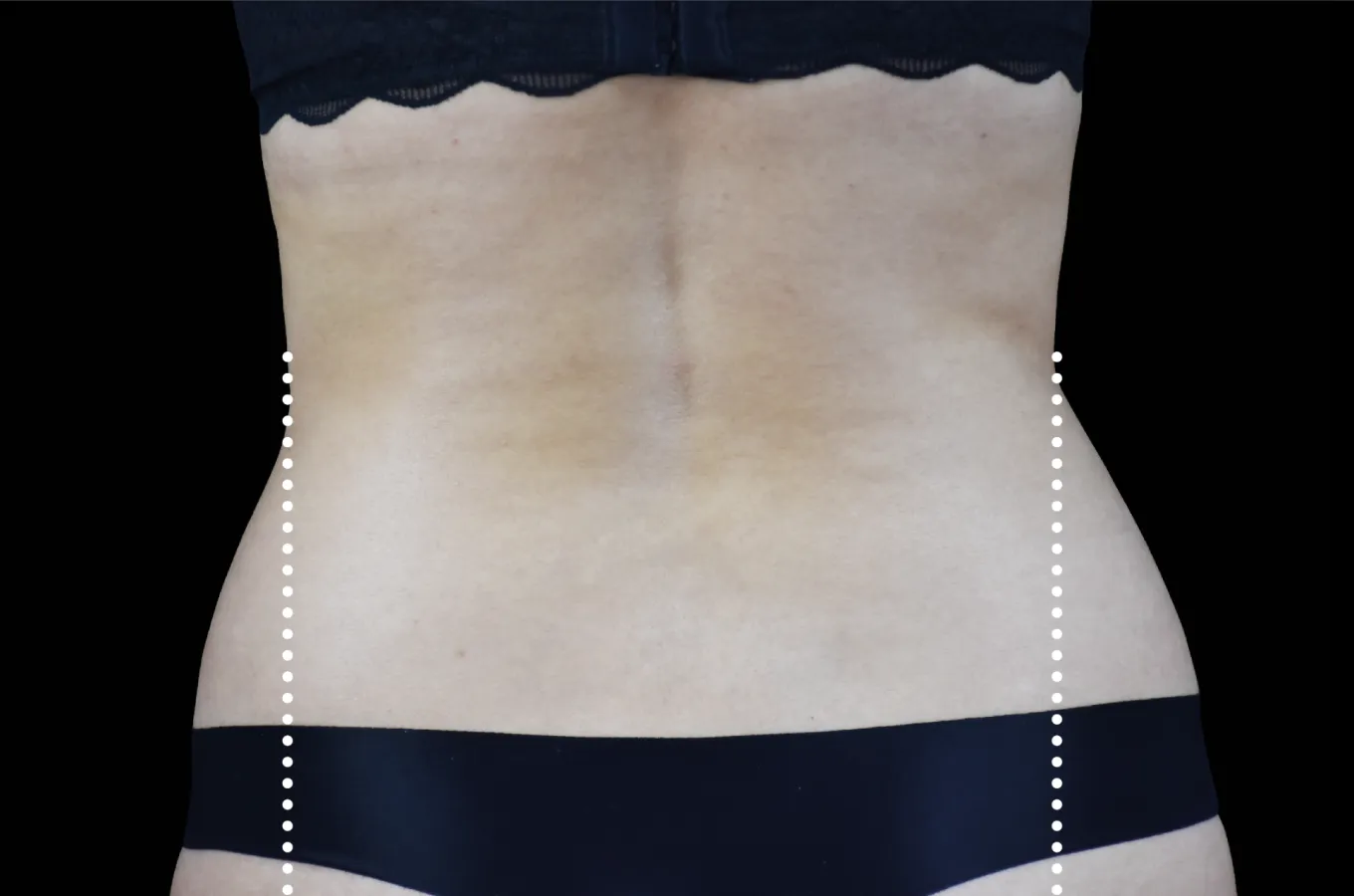 Lateral bild på abdomen efter BTL EMSCULPT NEO-behandling som visar resultat på sidan av magen.