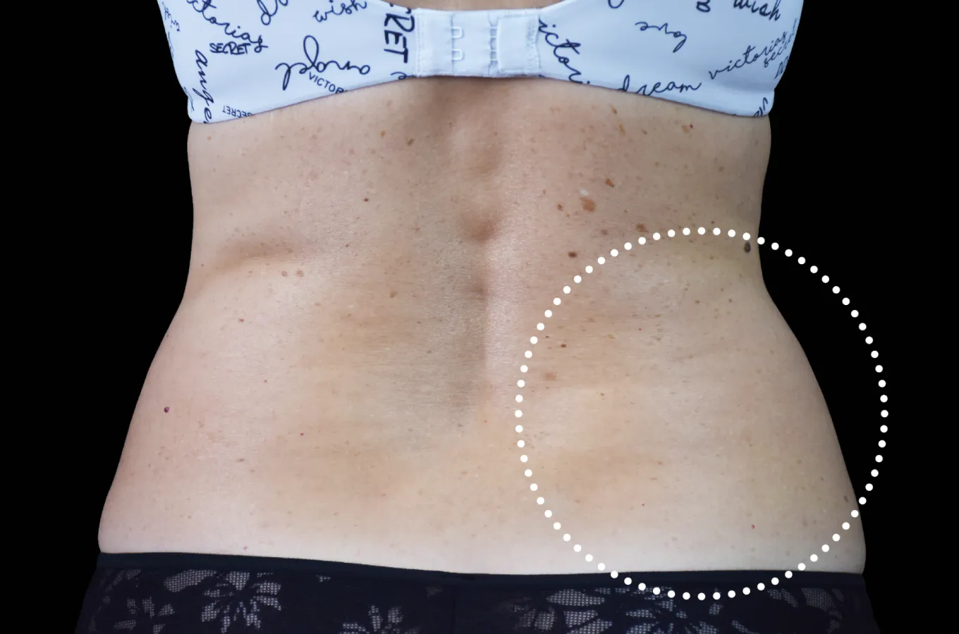 Lateralvy av kvinnas abdomen före BTL EMSCULPT NEO-behandling.